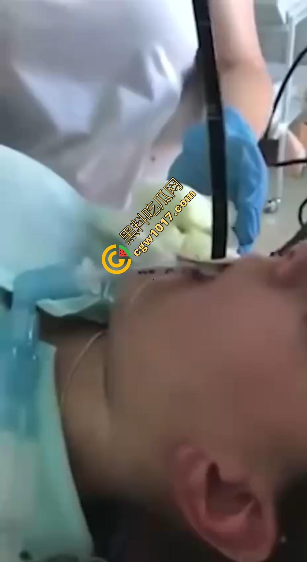 俄罗斯医院活拽1米毒蛇！女患者吞蛇卵孵化钻喉，医生手抖拽出瞬间到处乱窜！  第1张