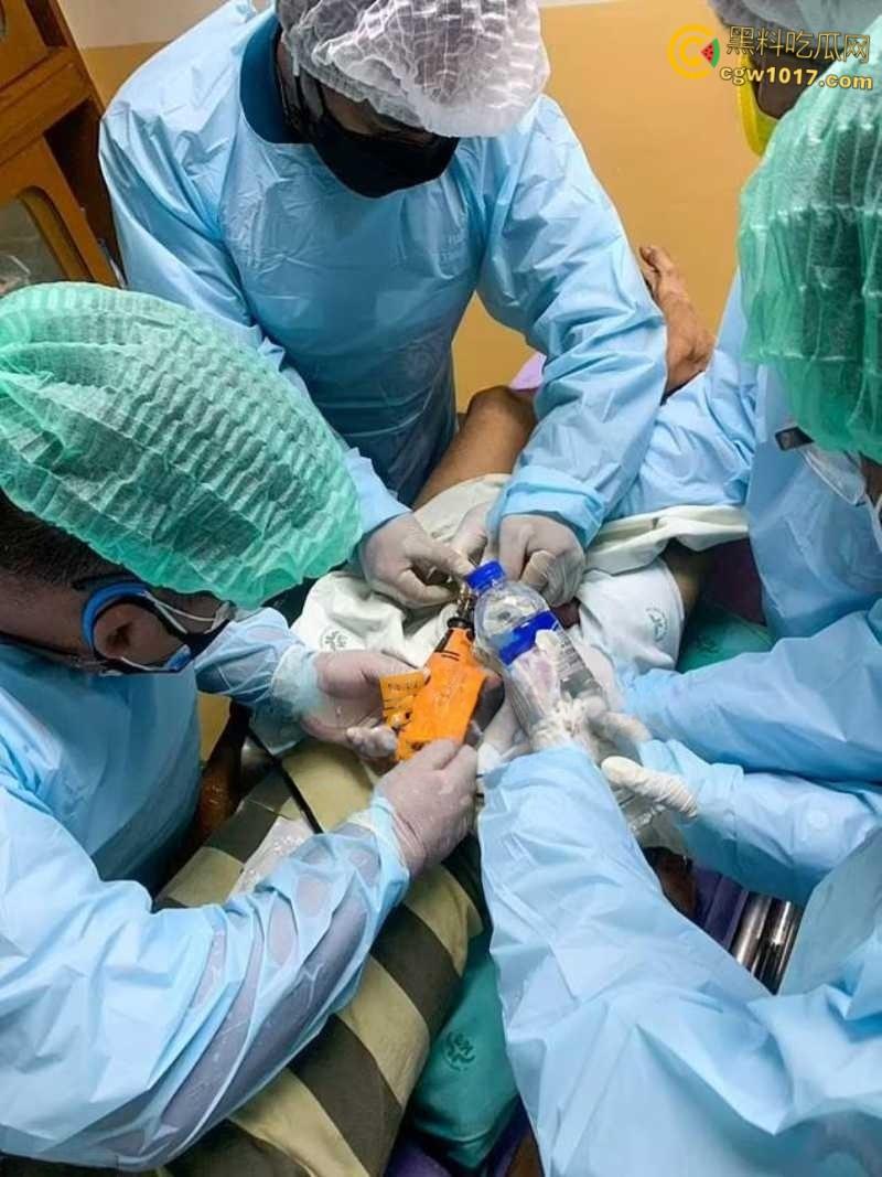 小说照进现实，男子追求刺激螺母自慰，勃起后被螺母卡住，消防人员和医生同时出动，解救被困阴茎 ！  第3张