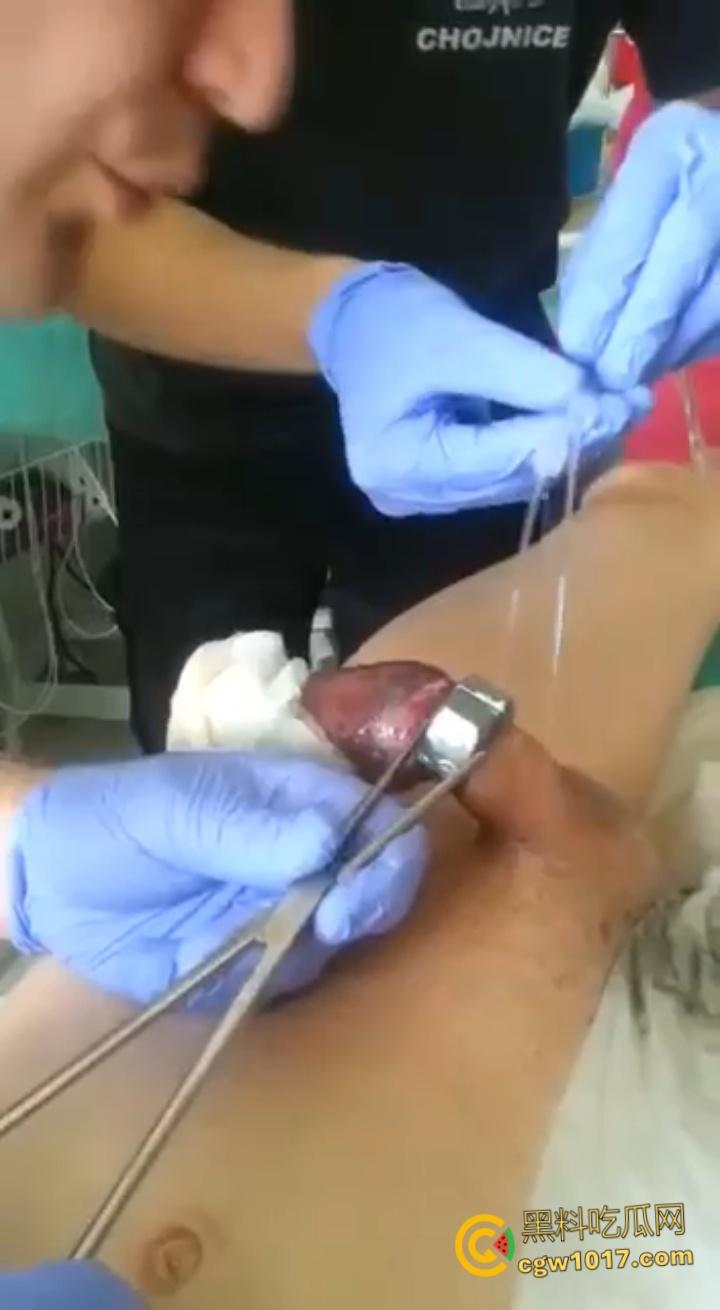 小说照进现实，男子追求刺激螺母自慰，勃起后被螺母卡住，消防人员和医生同时出动，解救被困阴茎 ！  第7张