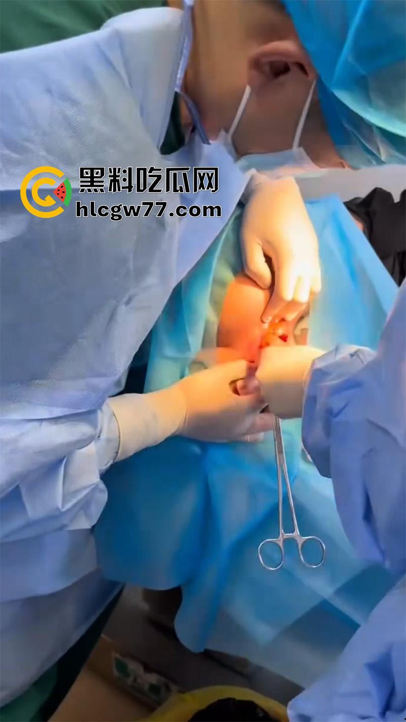 成都肛肠科又来新活，巨屌玩具塞入菊花拔不出来，只能到医院取出，这么大怎么塞进去的呢？  第1张