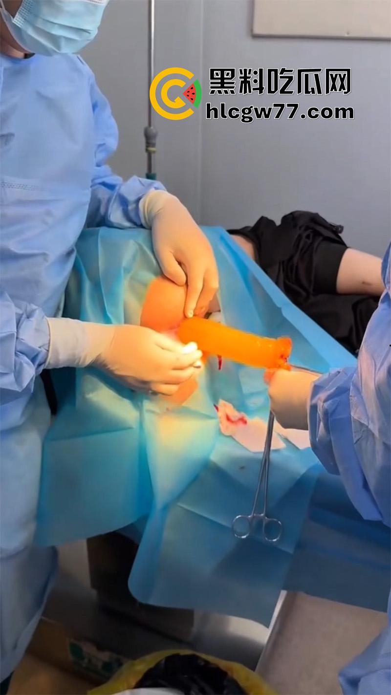 成都肛肠科又来新活，巨屌玩具塞入菊花拔不出来，只能到医院取出，这么大怎么塞进去的呢？  第7张
