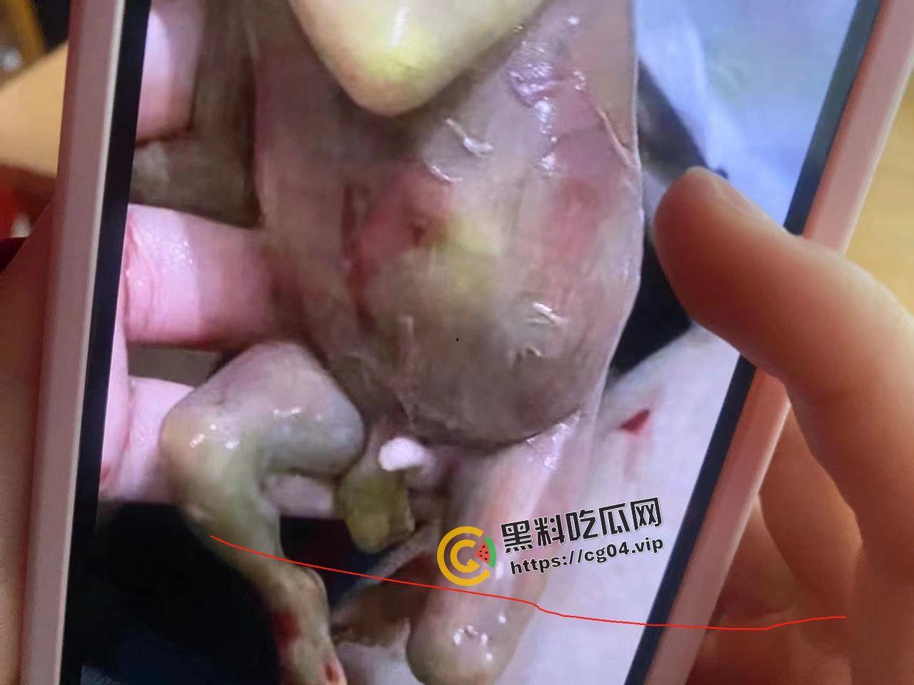 广西商业技师学幼教专业女生厕所早产 四度撕裂  母子双双进ICU 第7张